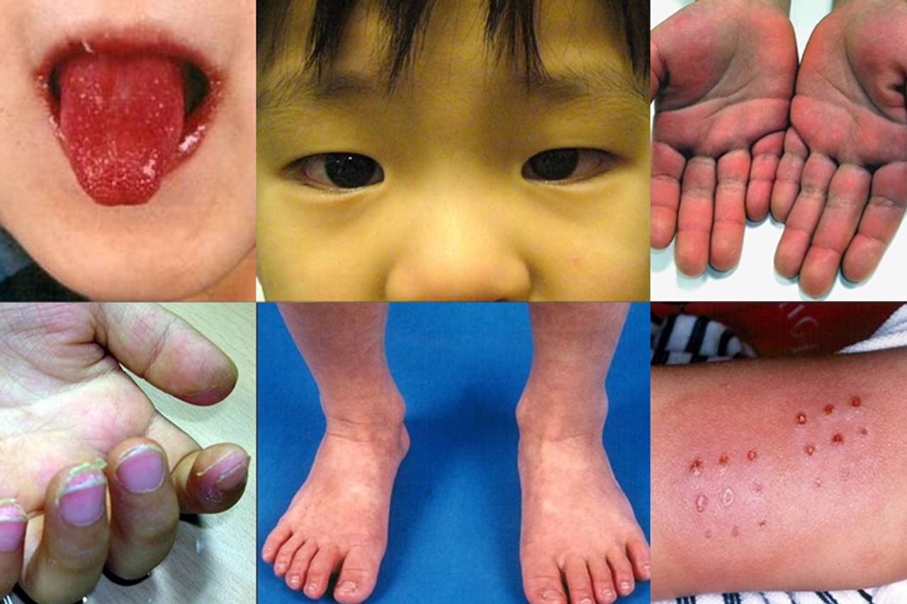 Kawasaki-like disease afflicting young children teens infection with SARS-CoV-2 - World Socialist Web Site