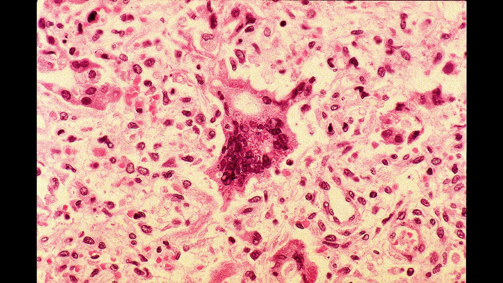 UK loses measles elimination status  amid sustained assault on public health